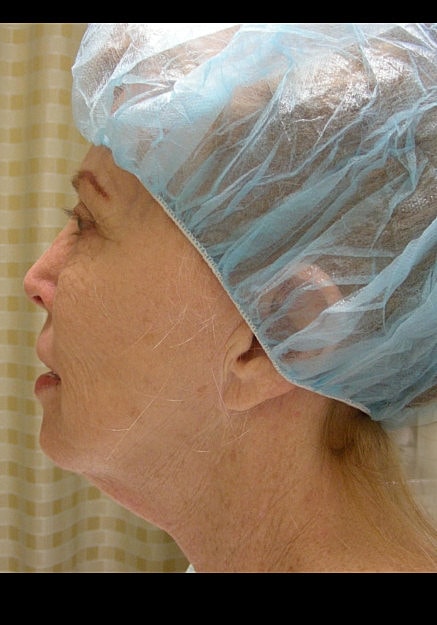 Facelift Before & After