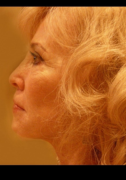 Facelift Before & After