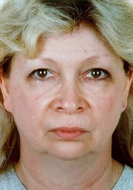 Facelift Before & After