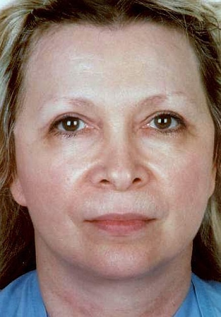 Facelift Before & After