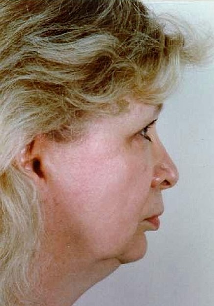 Facelift Before & After