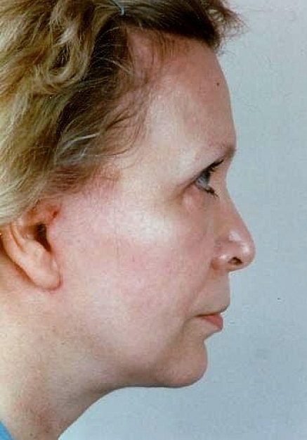 Facelift Before & After