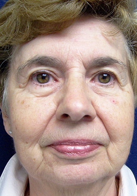 Facelift Before & After