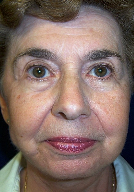 Facelift Before & After