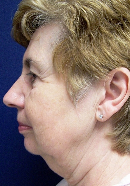 Facelift Before & After