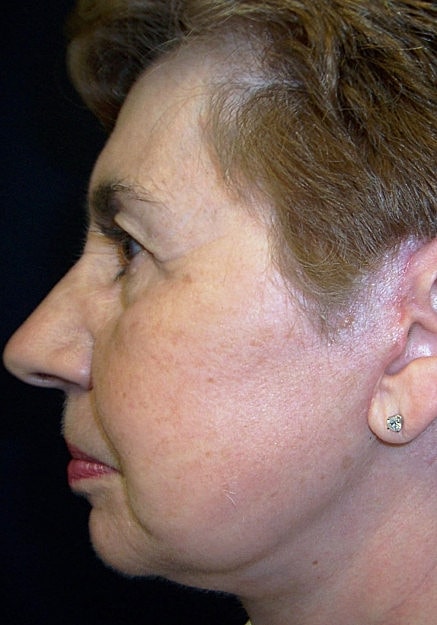 Facelift Before & After
