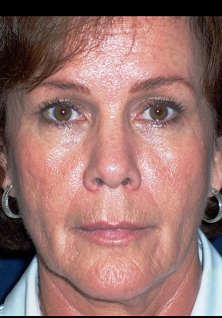 Facelift Before & After