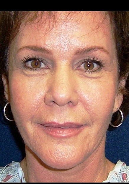 Facelift Before & After