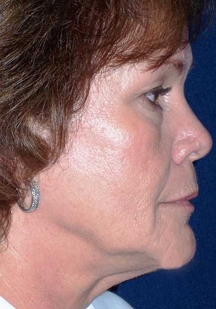 Facelift Before & After