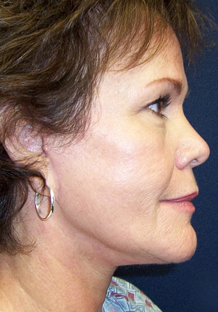 Facelift Before & After