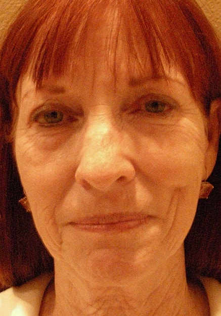 Facelift Before & After