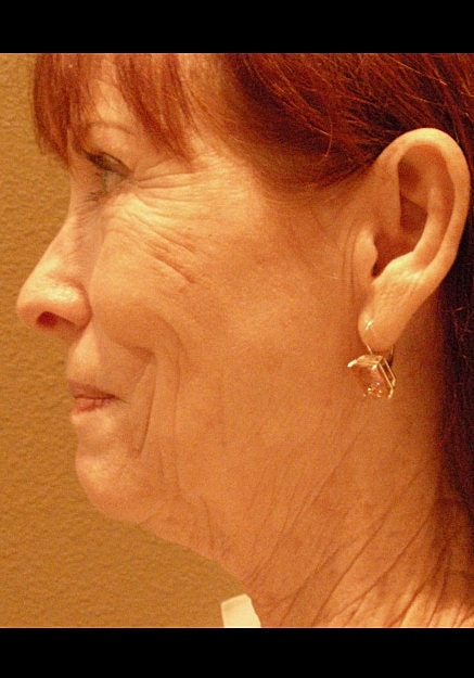 Facelift Before & After