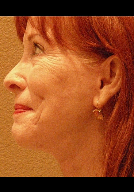 Facelift Before & After