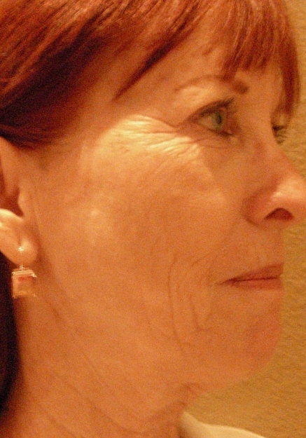 Facelift Before & After
