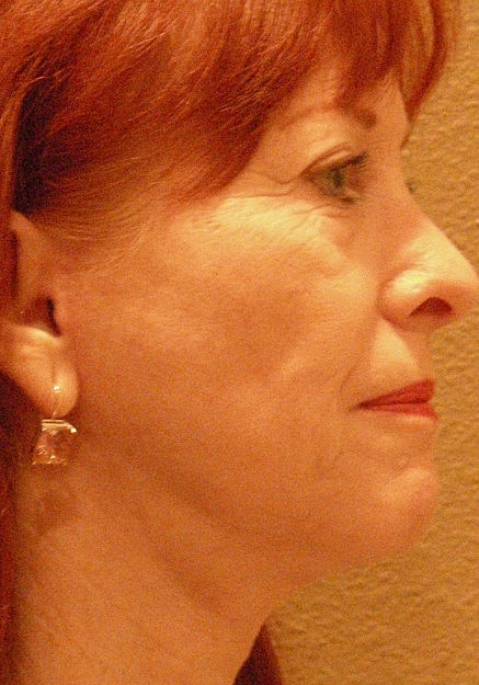 Facelift Before & After
