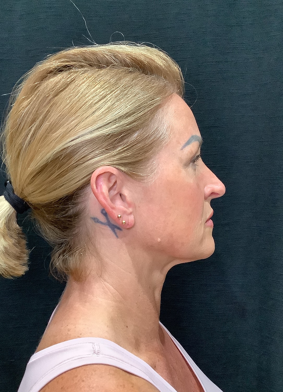 Facelift Before & After