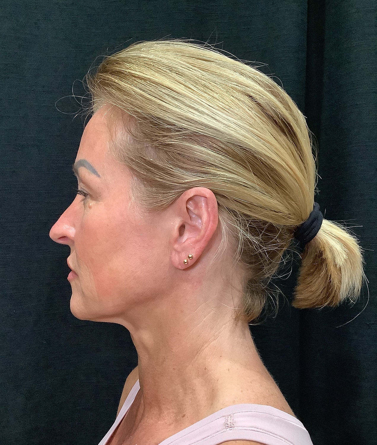 Facelift Before & After