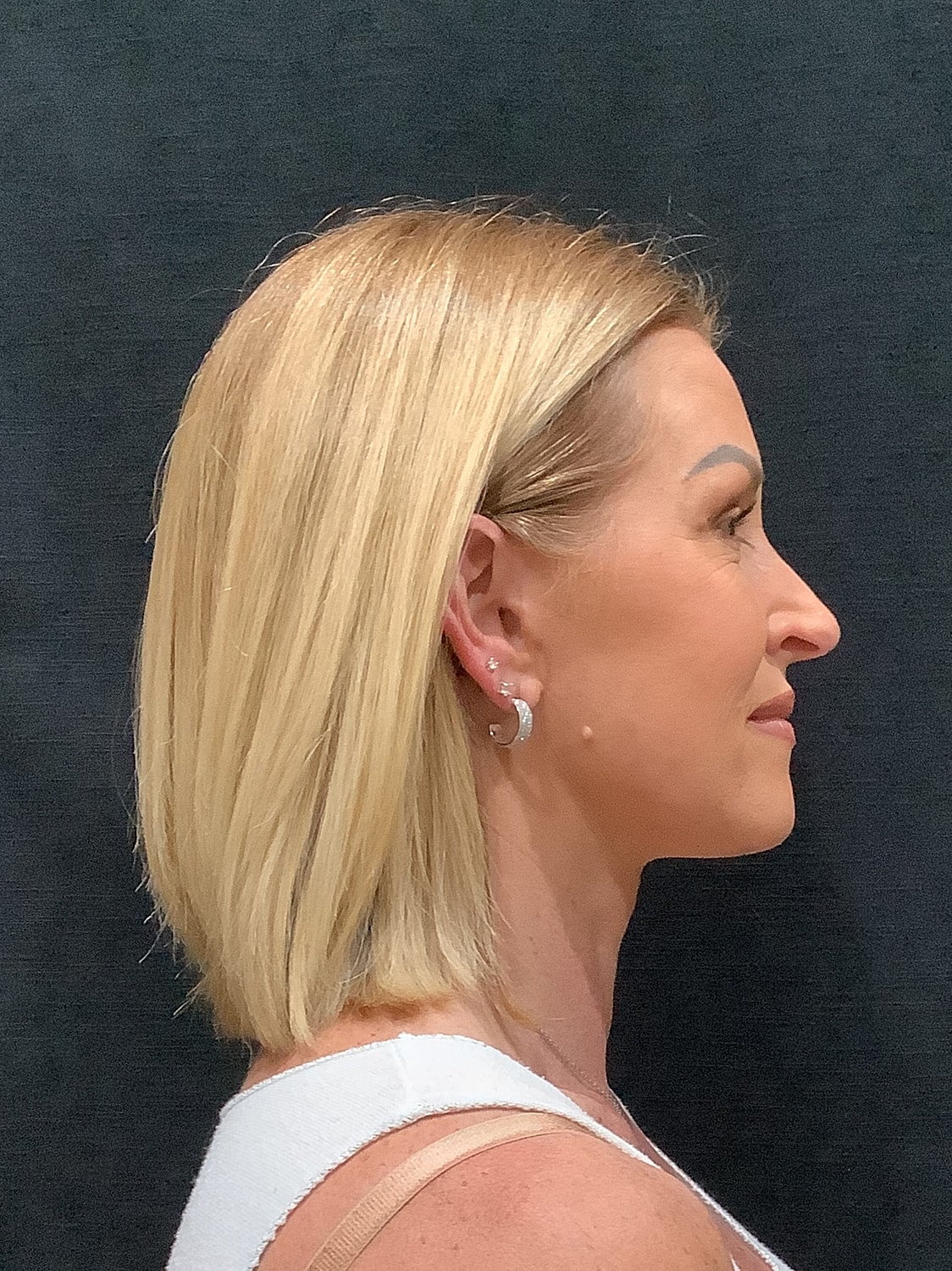 Facelift Before & After