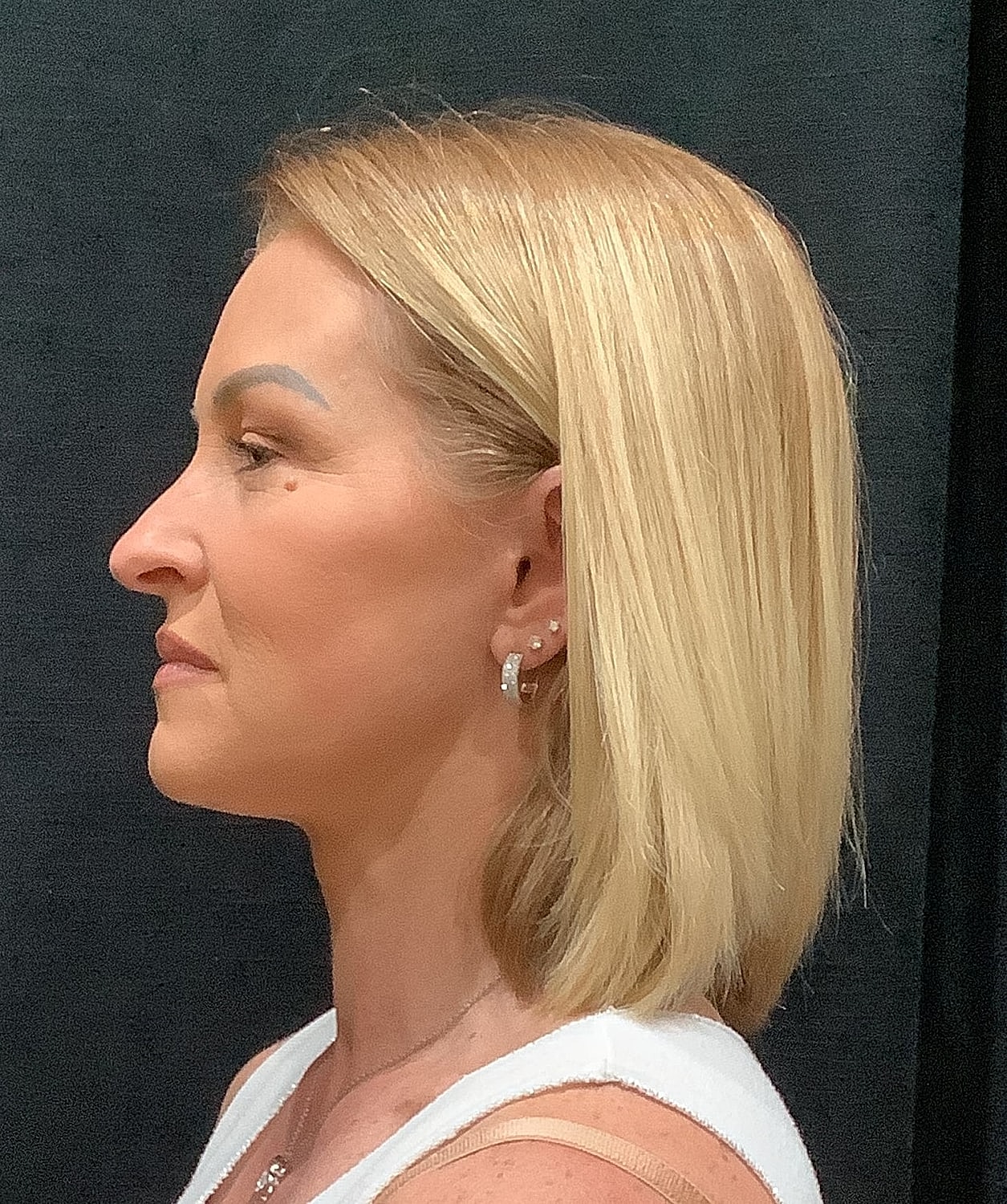 Facelift Before & After