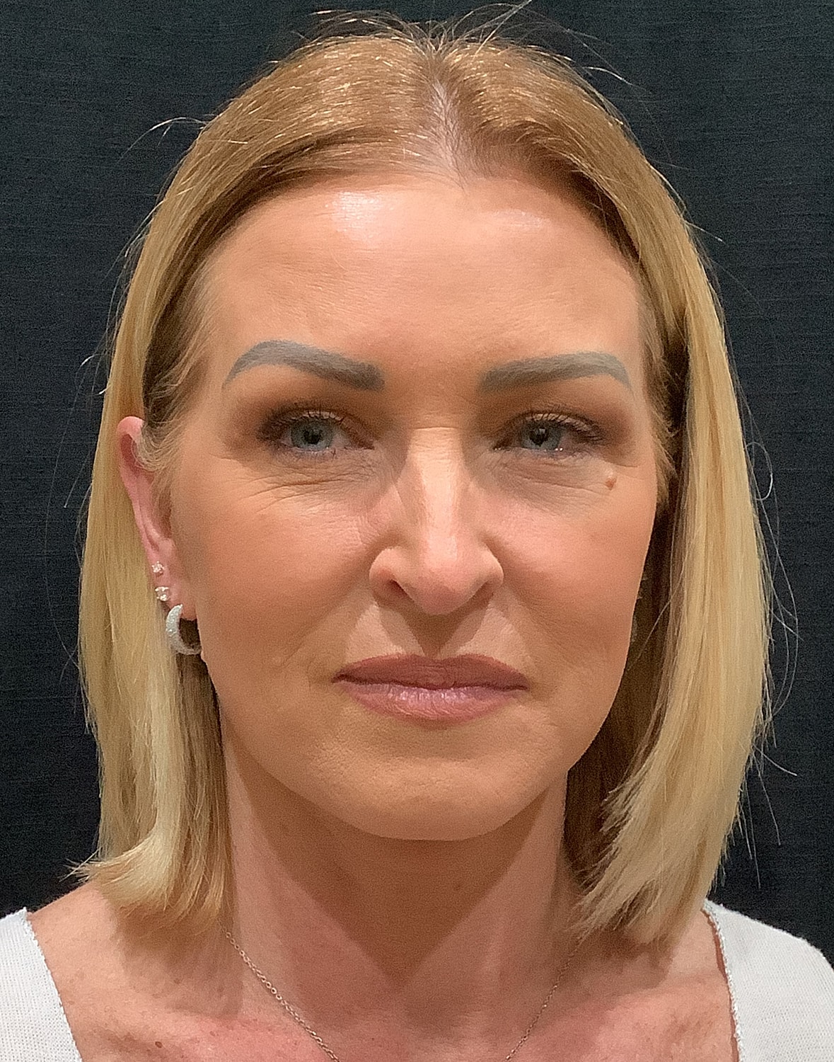 Facelift Before & After