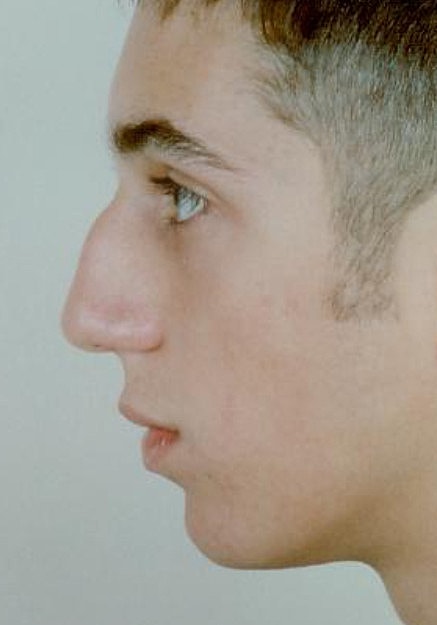 Rhinoplasty Before & After