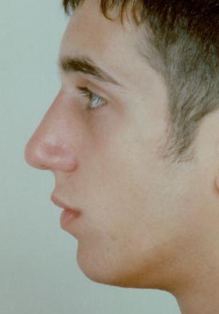 Rhinoplasty Before & After