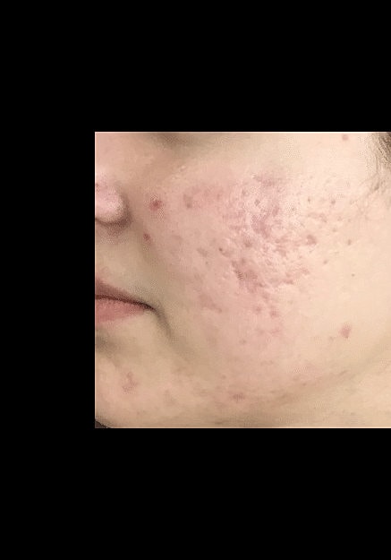 Skin Pen Microneedling Before & After