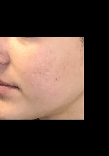 Skin Pen Microneedling Before & After