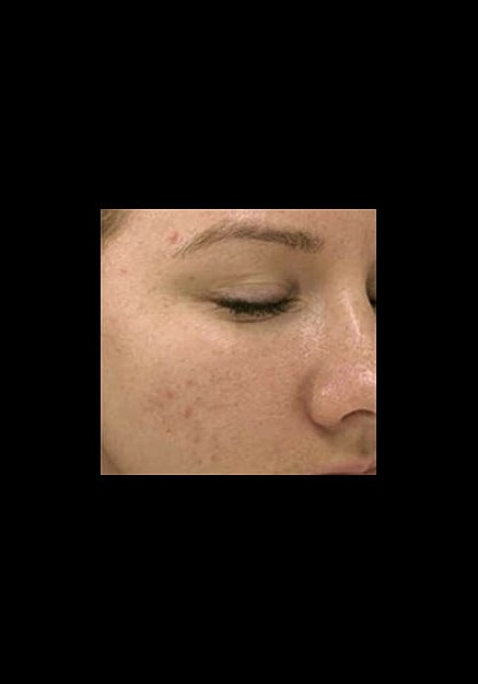 Skin Pen Microneedling Before & After