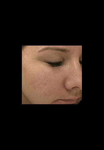 Skin Pen Microneedling Before & After