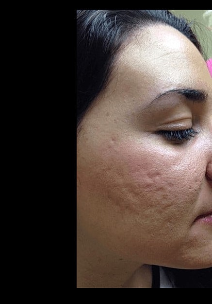 Skin Pen Microneedling Before & After