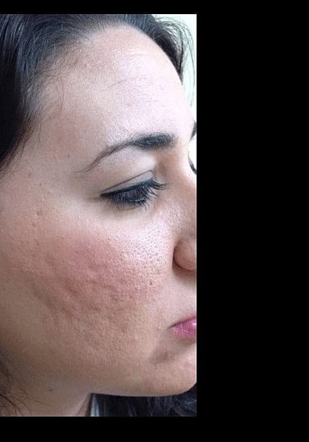Skin Pen Microneedling Before & After
