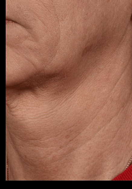 Skin Pen Microneedling Before & After
