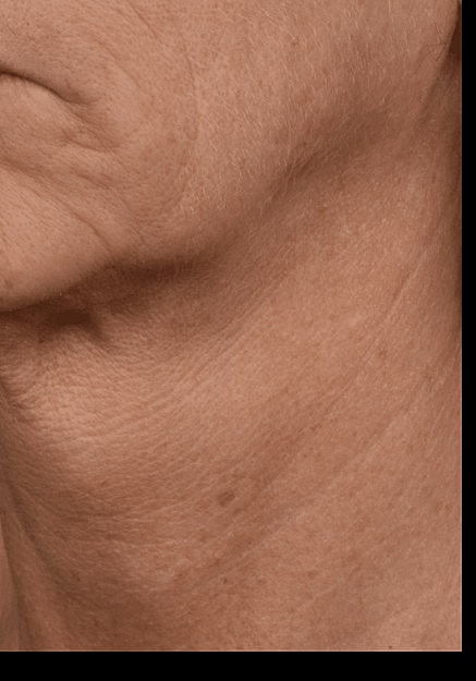 Skin Pen Microneedling Before & After