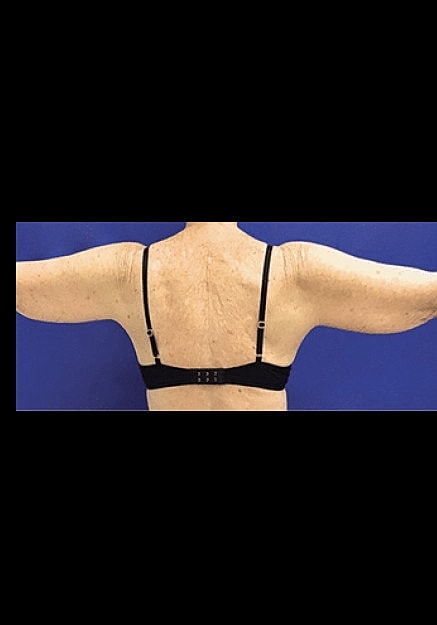 Renuvion Skin Tightening Before & After