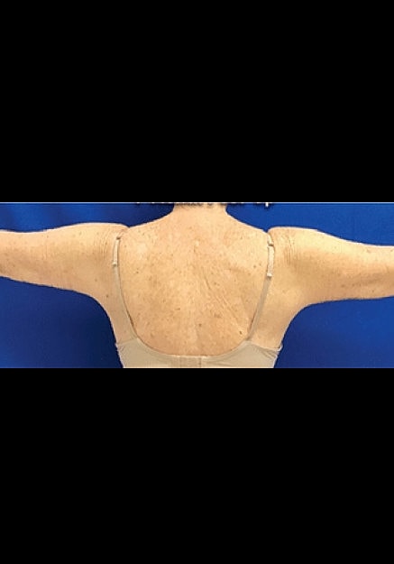 Renuvion Skin Tightening Before & After