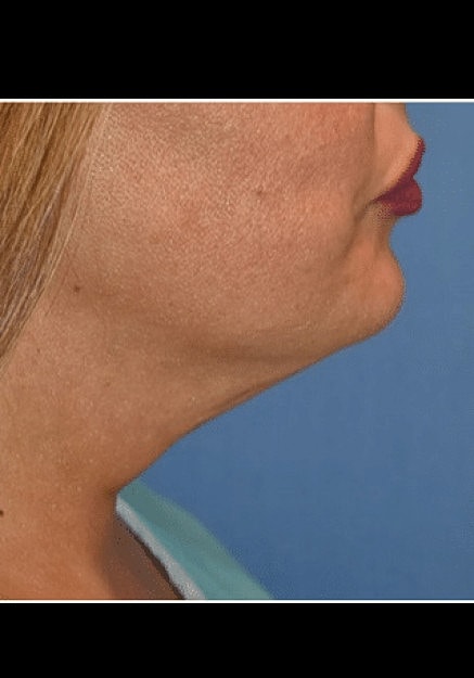 Renuvion Skin Tightening Before & After