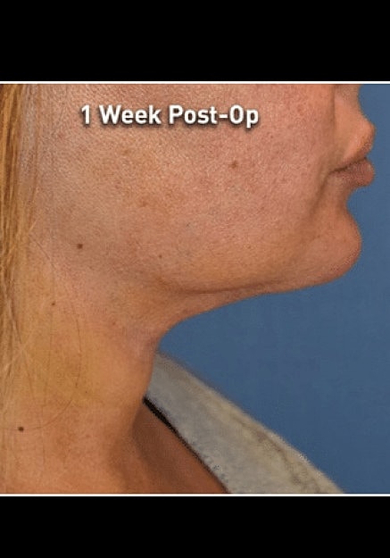Renuvion Skin Tightening Before & After
