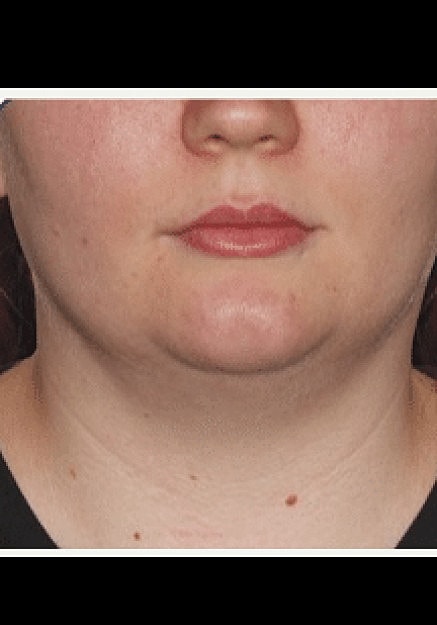 Renuvion Skin Tightening Before & After
