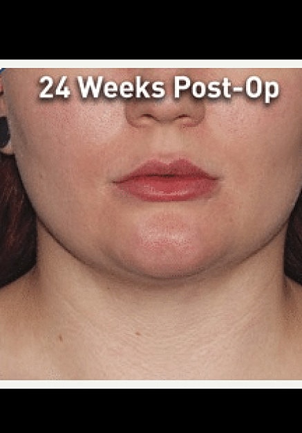 Renuvion Skin Tightening Before & After