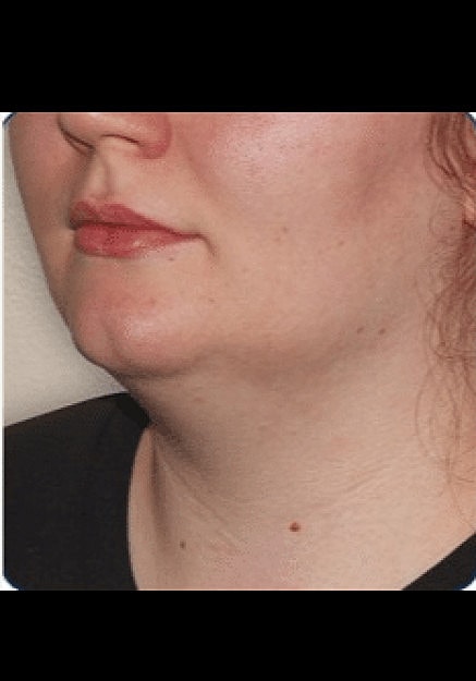 Renuvion Skin Tightening Before & After