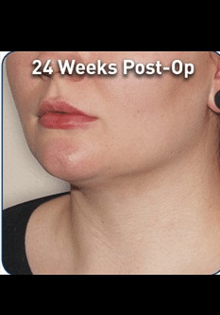 Renuvion Skin Tightening Before & After