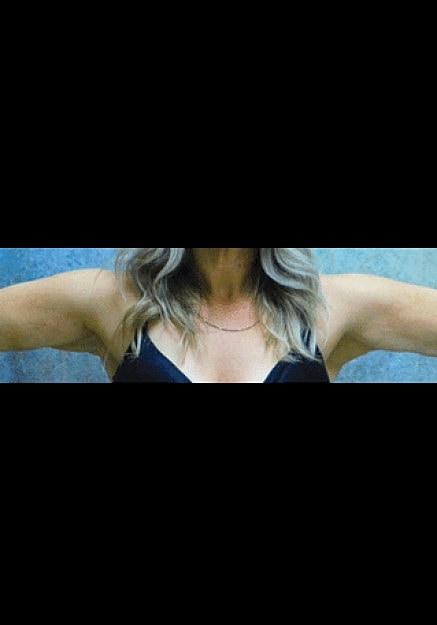 Renuvion Skin Tightening Before & After