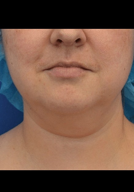 Renuvion Skin Tightening Before & After