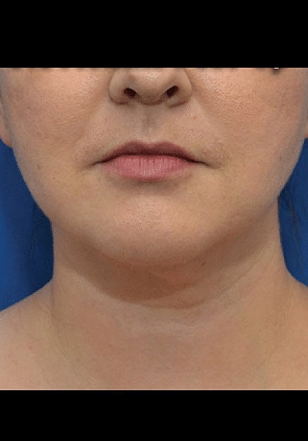 Renuvion Skin Tightening Before & After