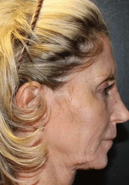 Renuvion Skin Tightening Before & After