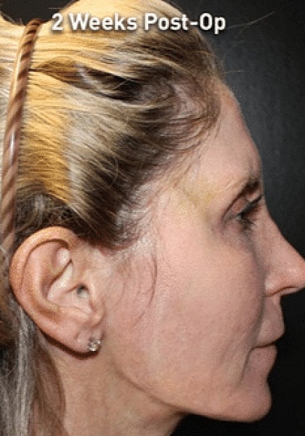 Renuvion Skin Tightening Before & After