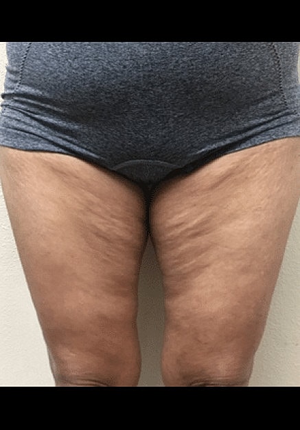 Renuvion Skin Tightening Before & After