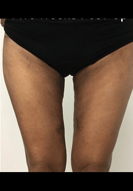 Renuvion Skin Tightening Before & After