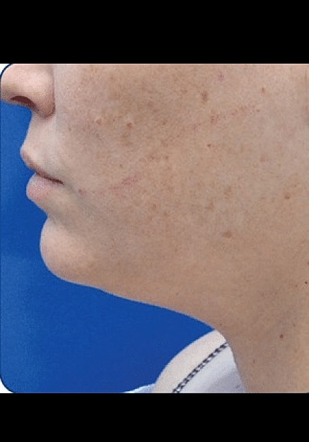 Renuvion Skin Tightening Before & After